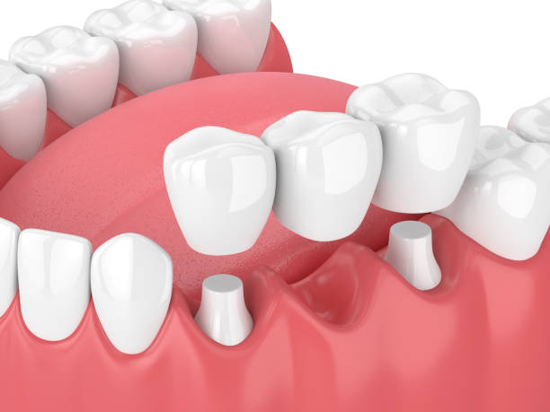 Dental Crown Houston