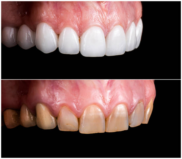 Dental Crown Houston